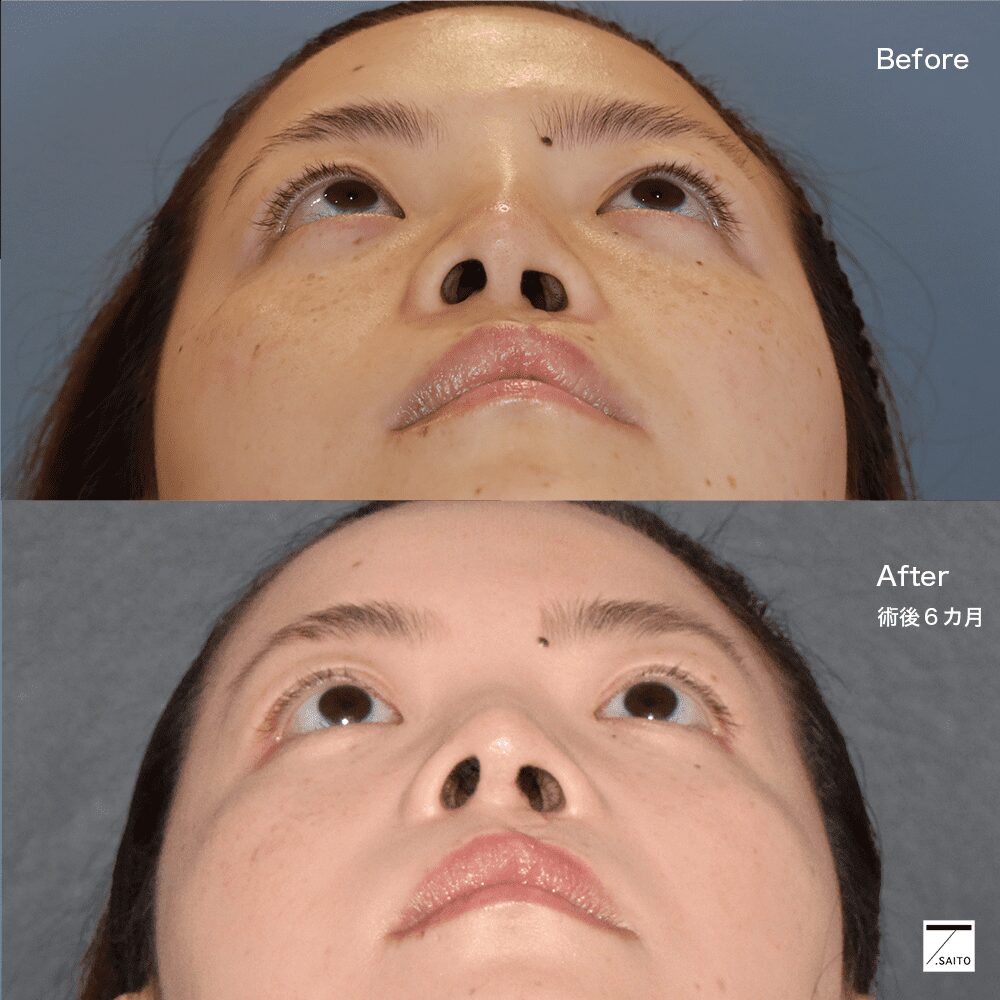 口唇口蓋裂　鼻修正　手術　術前後　鼻中隔延長６