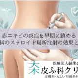 赤ニキビの炎症を早期に鎮める｜皮膚科のステロイド局所注射の効果と適応