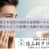 男子中高生の頑固な思春期ニキビ｜男性ホルモンの影響と洗顔不足の改善