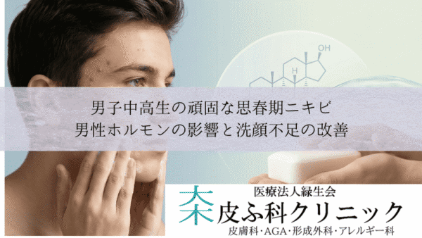 男子中高生の頑固な思春期ニキビ｜男性ホルモンの影響と洗顔不足の改善