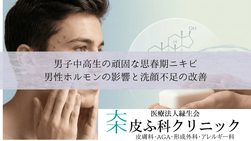 男子中高生の頑固な思春期ニキビ｜男性ホルモンの影響と洗顔不足の改善