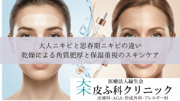 大人ニキビと思春期ニキビの違い｜乾燥による角質肥厚と保湿重視のスキンケア