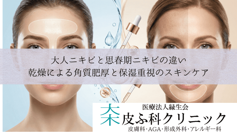 大人ニキビと思春期ニキビの違い｜乾燥による角質肥厚と保湿重視のスキンケア