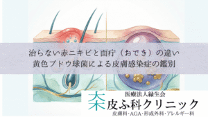 治らない赤ニキビと面疔（おでき）の違い｜黄色ブドウ球菌による皮膚感染症の鑑別
