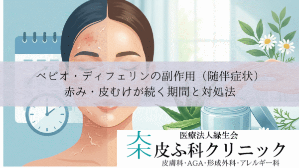 ベピオ・ディフェリンの副作用（随伴症状）｜赤み・皮むけが続く期間と対処法