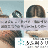 脂漏性皮膚炎による抜け毛（脂漏性脱毛症）｜頭皮環境の改善とAGAとの違い