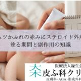 オムツかぶれの赤みにステロイド外用薬（ロコイド）｜塗る期間と副作用の知識