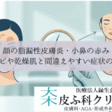顔の脂漏性皮膚炎・小鼻の赤み｜ニキビや乾燥肌と間違えやすい症状の鑑別