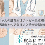 赤ちゃんの肌荒れはアトピー性皮膚炎？｜乳児湿疹との見分け方と診断時期の目安