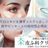 自分で白ニキビを潰すリスクと正しい対処｜針やピンセットの使用禁止理由