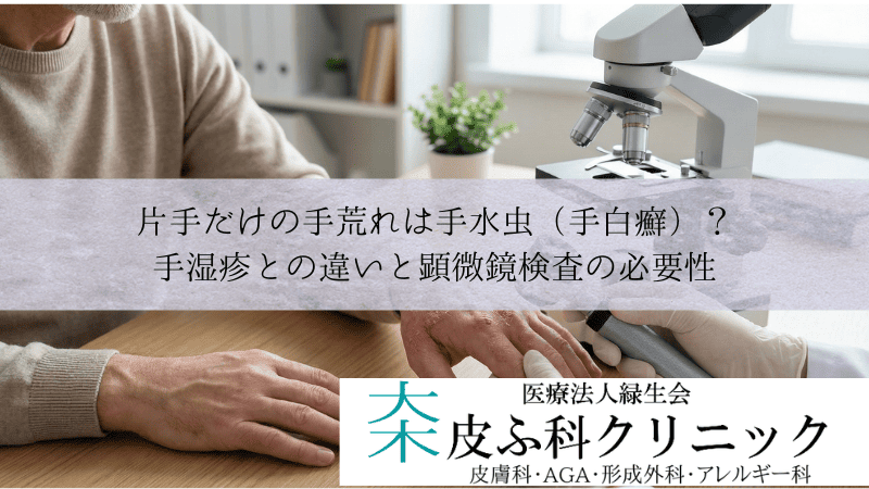 片手だけの手荒れは手水虫（手白癬）？｜手湿疹との違いと顕微鏡検査の必要性