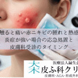 触ると痛い赤ニキビの腫れと熱感｜炎症が強い場合の応急処置と皮膚科受診のタイミング