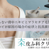 治らない背中ニキビとマラセチア毛包炎｜カビが原因の場合の症状と抗真菌薬
