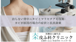 治らない背中ニキビとマラセチア毛包炎|カビが原因の場合の症状と抗真菌薬