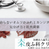 治らないオムツかぶれとカンジダ（乳児寄生菌性紅斑）｜見分け方と抗真菌薬