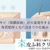白ニキビ（閉鎖面皰）が大量発生する原因｜角質肥厚と毛穴詰まりの仕組み