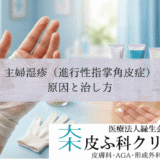 主婦湿疹（進行性指掌角皮症）の原因と治し方｜洗剤かぶれとゴム手袋の選び方