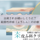 虫刺されが硬いしこりに？結節性痒疹（ようしん）の治療｜ステロイド注射とテープ剤