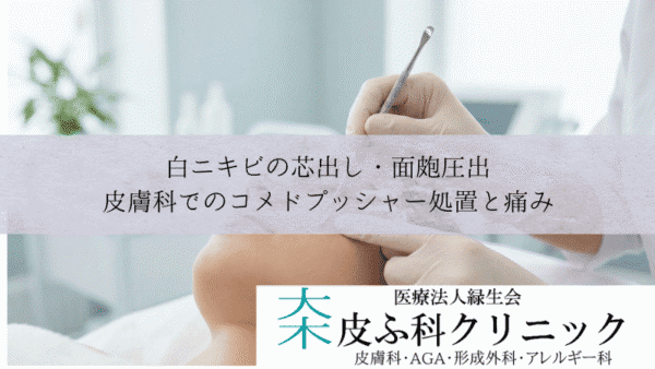 白ニキビの芯出し・面皰圧出｜皮膚科でのコメドプッシャー処置と痛み
