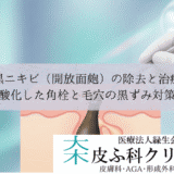 黒ニキビ（開放面皰）の除去と治療｜酸化した角栓と毛穴の黒ずみ対策