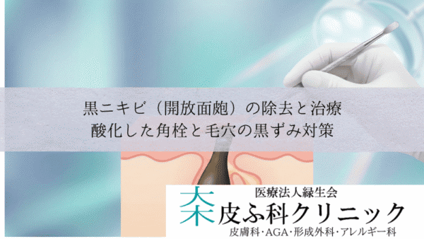 黒ニキビ（開放面皰）の除去と治療｜酸化した角栓と毛穴の黒ずみ対策