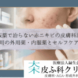 市販薬で治らない赤ニキビの皮膚科治療｜保険適用の外用薬・内服薬とセルフケアの限界