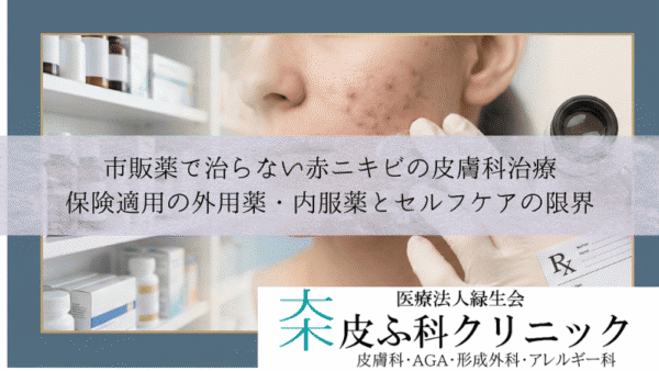 市販薬で治らない赤ニキビの皮膚科治療｜保険適用の外用薬・内服薬とセルフケアの限界