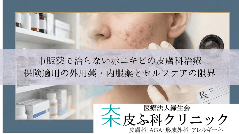 市販薬で治らない赤ニキビの皮膚科治療｜保険適用の外用薬・内服薬とセルフケアの限界