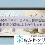 お尻のニキビ・黒ずみと臀部毛包炎｜長時間の圧迫による角化と治療法