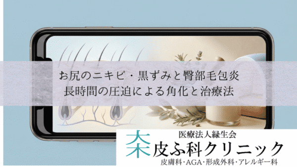 お尻のニキビ・黒ずみと臀部毛包炎｜長時間の圧迫による角化と治療法