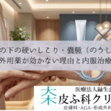 皮膚の下の硬いしこり・嚢腫（のうしゅ）｜外用薬が効かない理由と内服治療