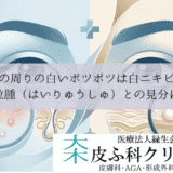 目の周りの白いポツポツは白ニキビ？稗粒腫（はいりゅうしゅ）との見分け方