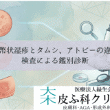 貨幣状湿疹とタムシ（体部白癬）・アトピーの違い｜検査による鑑別診断