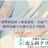 治らない貨幣状湿疹と病巣感染・金属アレルギー｜歯科治療で皮膚が治る可能性