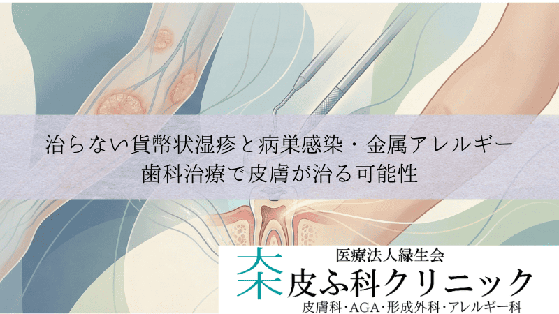 治らない貨幣状湿疹と病巣感染・金属アレルギー｜歯科治療で皮膚が治る可能性