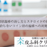 貨幣状湿疹の治し方とステロイドの強さ｜治らないコイン状の湿疹への対処