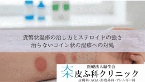 貨幣状湿疹の治し方とステロイドの強さ|治らないコイン状の湿疹への対処