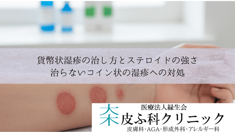 貨幣状湿疹の治し方とステロイドの強さ｜治らないコイン状の湿疹への対処