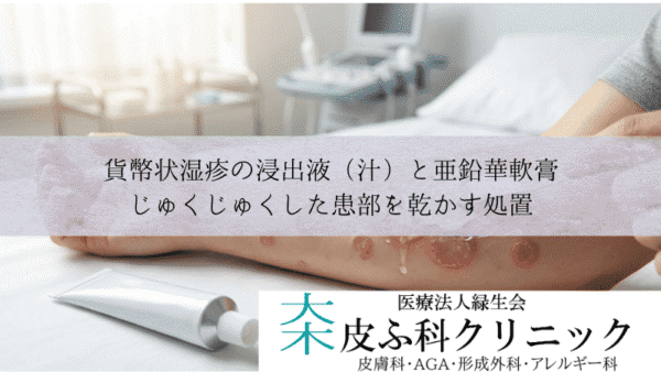 貨幣状湿疹の浸出液（汁）と亜鉛華軟膏｜じゅくじゅくした患部を乾かす処置