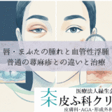 唇・まぶたの腫れと血管性浮腫（クインケ浮腫）｜普通の蕁麻疹との違いと治療