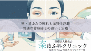 唇・まぶたの腫れと血管性浮腫(クインケ浮腫)|普通の蕁麻疹との違いと治療