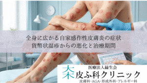 全身に広がる自家感作性皮膚炎の症状｜貨幣状湿疹からの悪化と治療期間