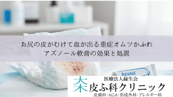 お尻の皮がむけて血が出る重症オムツかぶれ｜アズノール軟膏の効果と処置