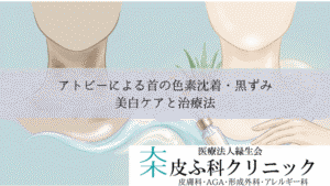 アトピーによる首の色素沈着・黒ずみ（ダーティネック）｜美白ケアと治療法
