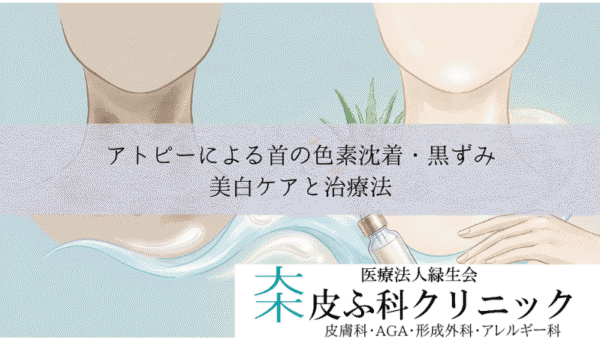 アトピーによる首の色素沈着・黒ずみ（ダーティネック）｜美白ケアと治療法