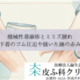 機械性蕁麻疹（人工蕁麻疹）とミミズ腫れ｜下着のゴム圧迫や掻いた跡の赤み