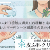 かぶれ（接触皮膚炎）の種類と違い｜アレルギー性と一次刺激性の見分け方