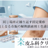 同じ場所に繰り返す固定薬疹｜原因となる市販の解熱鎮痛剤と色素沈着