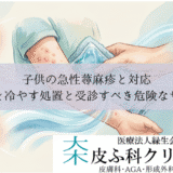 子供の急性蕁麻疹と対応｜患部を冷やす処置と受診すべき危険なサイン