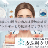 食後の口周りの赤みは接触皮膚炎？｜食物アレルギーとの見分け方とワセリン保護